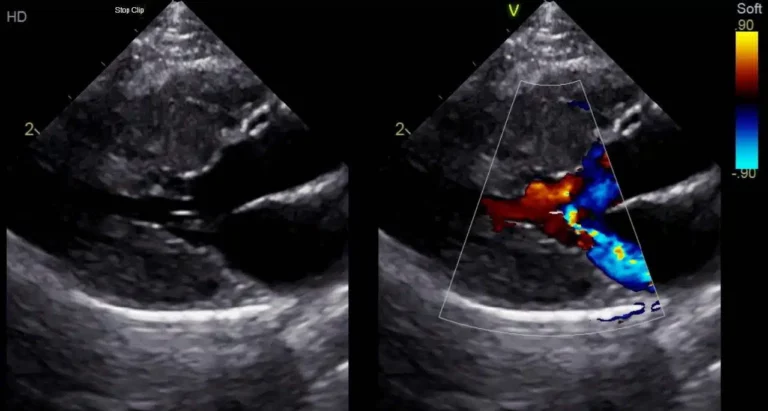 cardiomyopathie hypertrophique