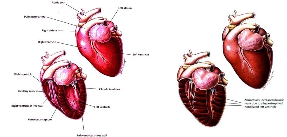 cardiomyopathie hypertrophique